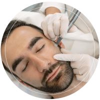 A man undergoing microneedling treatment