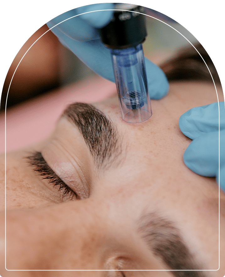 Microneedling a woman's forehead