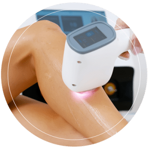 Laser Treatments On A Woman's Leg