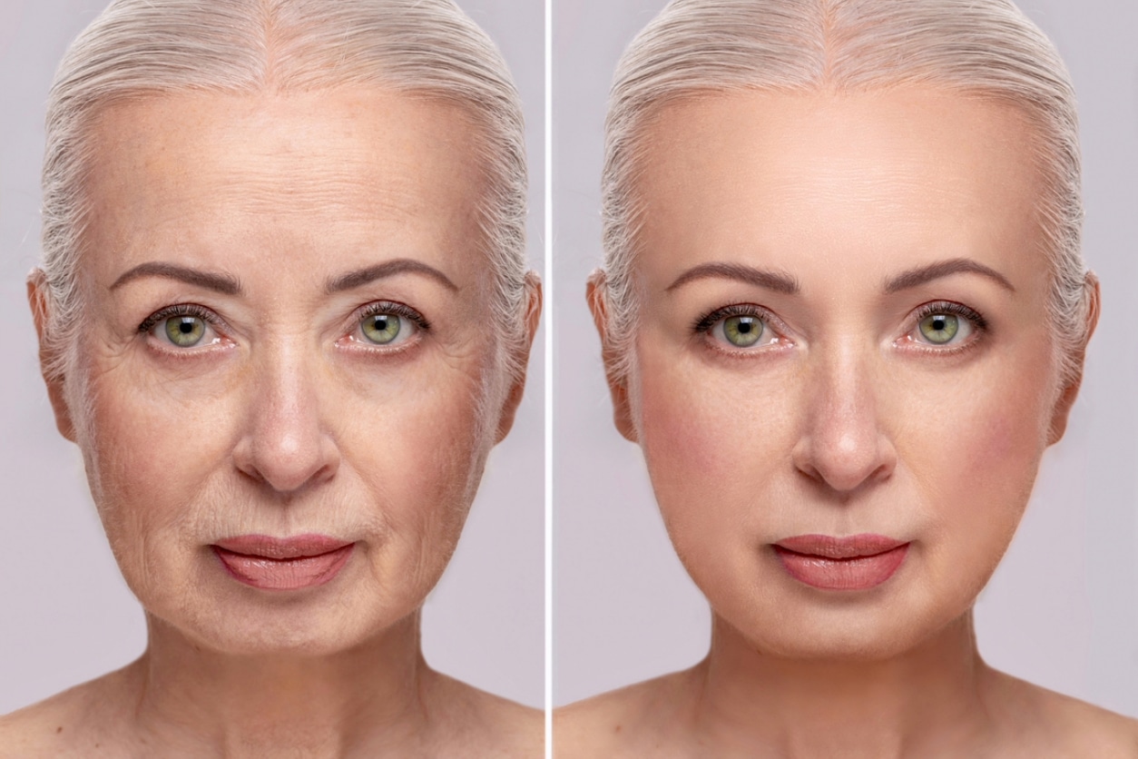 This is a before-and-after picture of a woman, one showing her wrinkles and sagging skin and one showing her more youthful appearance.