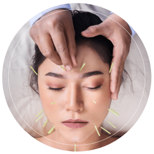 Woman Receiving Acupuncture