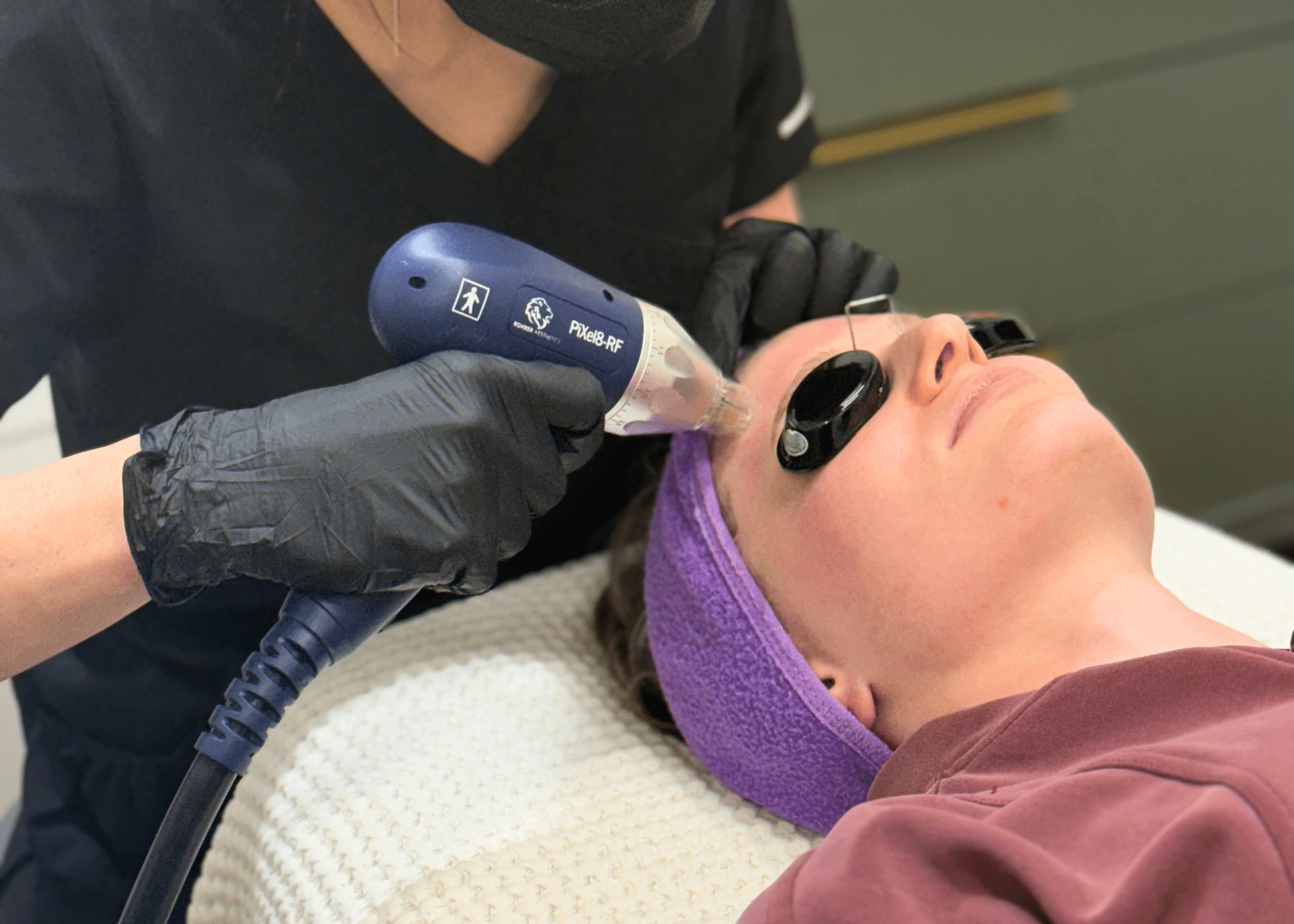 microneedling
